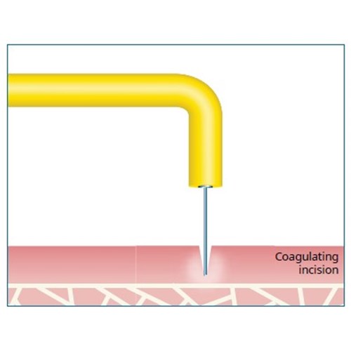 coagulating incision